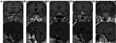 Risk factors and management associated with postoperative cerebrospinal fluid leak after endoscopic endonasal surgery for pituitary adenoma